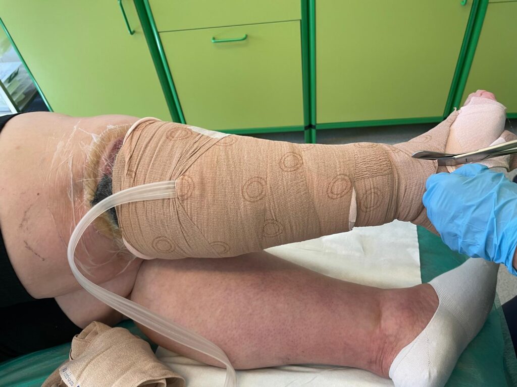 Terapia podciśnieniowa Bydgoszcz - aplikacja opatrunku NPWT na nogę